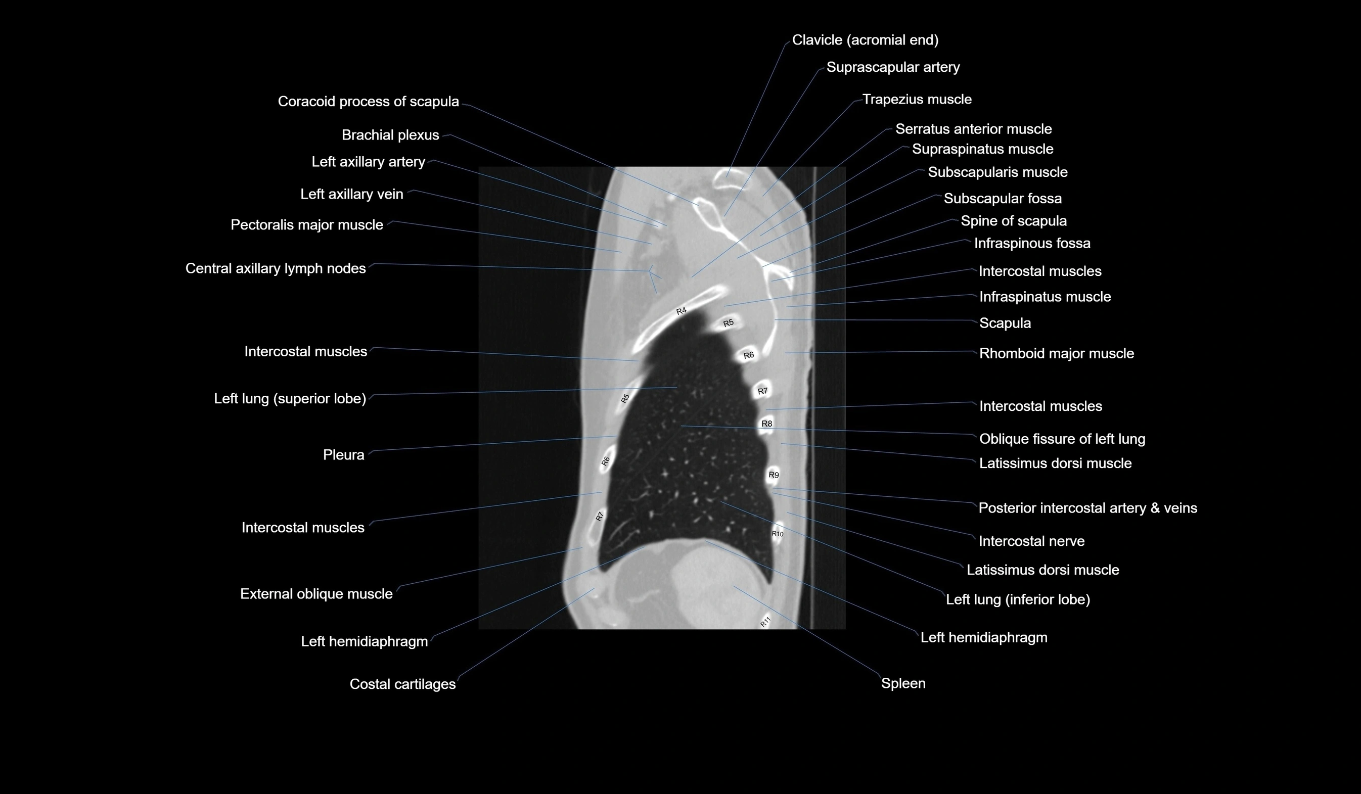 CT chest (thorax) labelled sagittal cross sectional anatomy radiology image-00124.webp